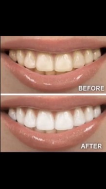 whitening_toothpaste_smile
